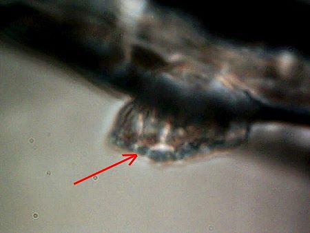 MORGELLONS: MORPHOLOGY CONFIRMED 10