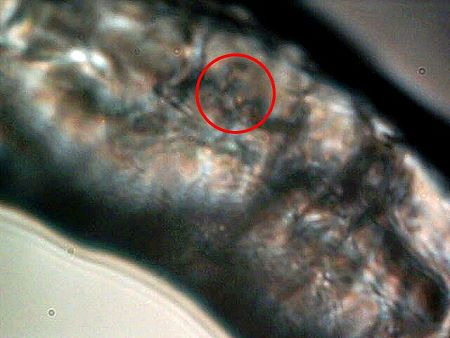 MORGELLONS: MORPHOLOGY CONFIRMED 9