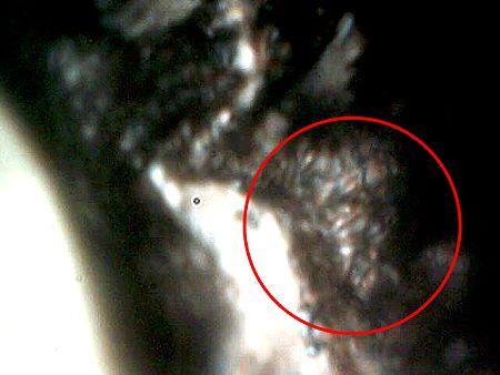 MORGELLONS: MORPHOLOGY CONFIRMED 8