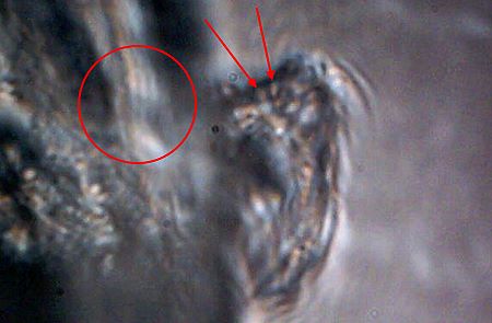 MORGELLONS: MORPHOLOGY CONFIRMED 12