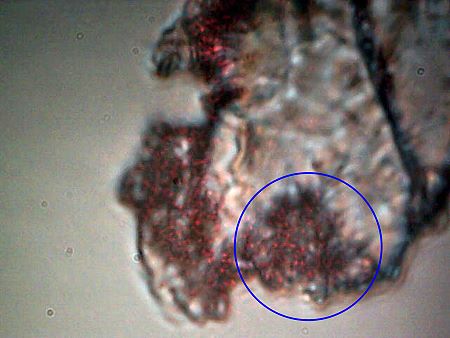 MORGELLONS: MORPHOLOGY CONFIRMED 14