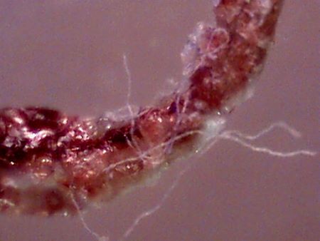 MORGELLONS: MORPHOLOGY CONFIRMED 5