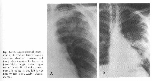 MYCOPLASMA PNEUMONIAE INFORMATION